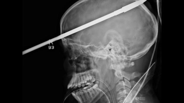 Teen survives spear impalement through skull 