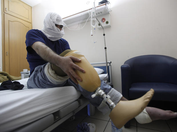Ahmad Mostafa, 27, a Syrian who lost his leg when government forces shelled Baba Amr 