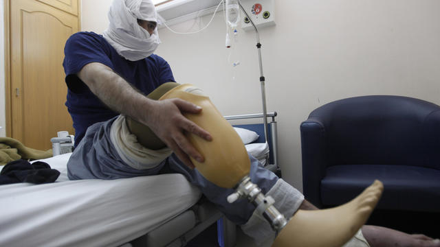 Ahmad Mostafa, 27, a Syrian who lost his leg when government forces shelled Baba Amr 