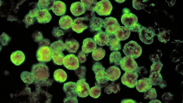 CDC releases experimental "brain-eating" amoeba drug 