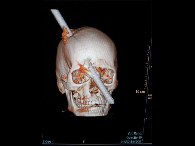 bar impales skull brazil 