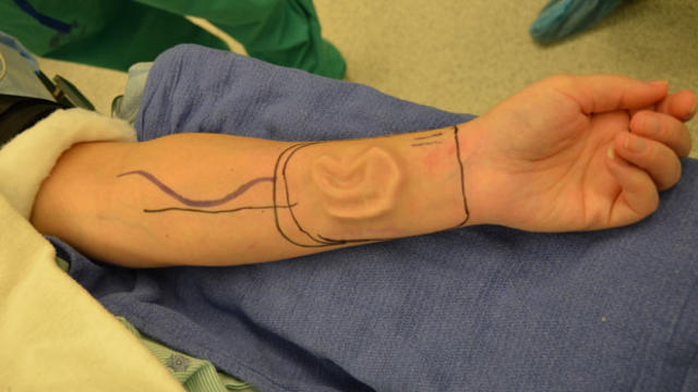 ear transplant, sherrie winters, johns hopkins 