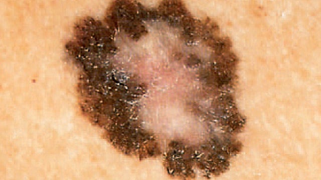 Vitamin B3 nicotinamide could help reduce skin cancer risk CBS News