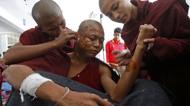 A severely burnt Buddhist monk receives treatment at a hospital after police fired water cannons and other devices during a pre-dawn crackdown on villagers and monks protesting a Chinese-backed copper mine in Monywa, Burma, Nov. 29, 2012. 