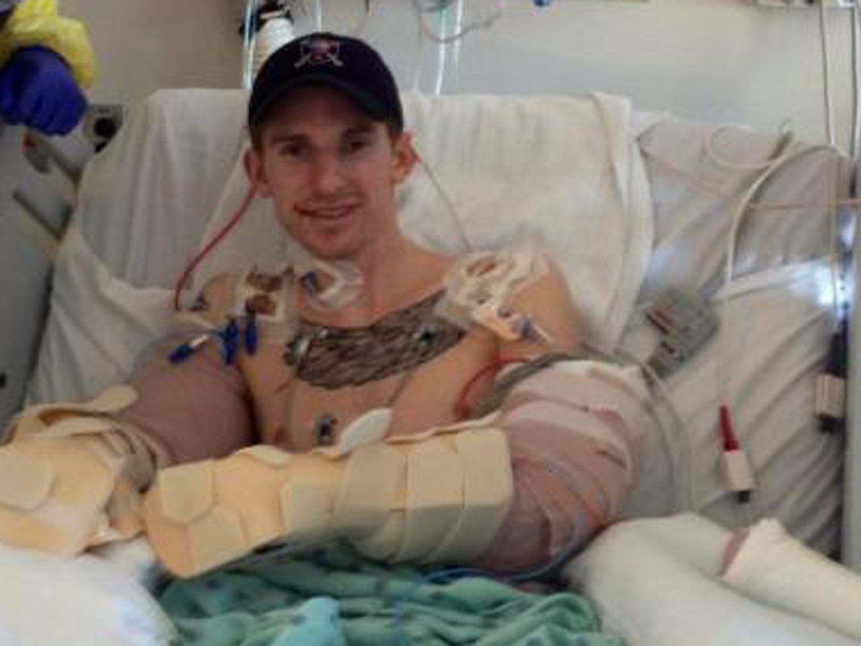 Quadruple amputee vet gets double arm transplant