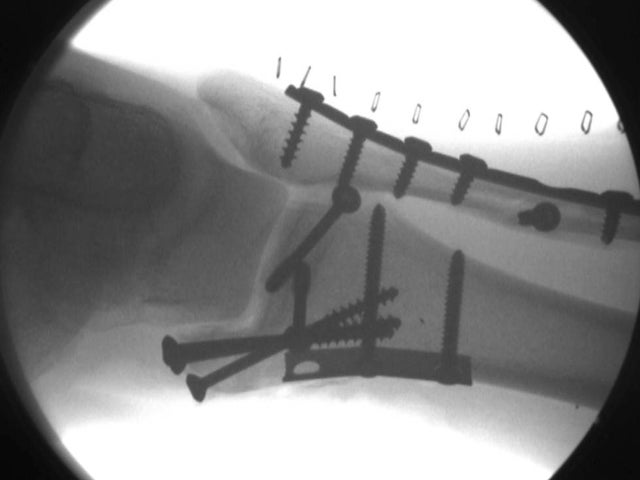 trampoline injury, broken ankle, screws 