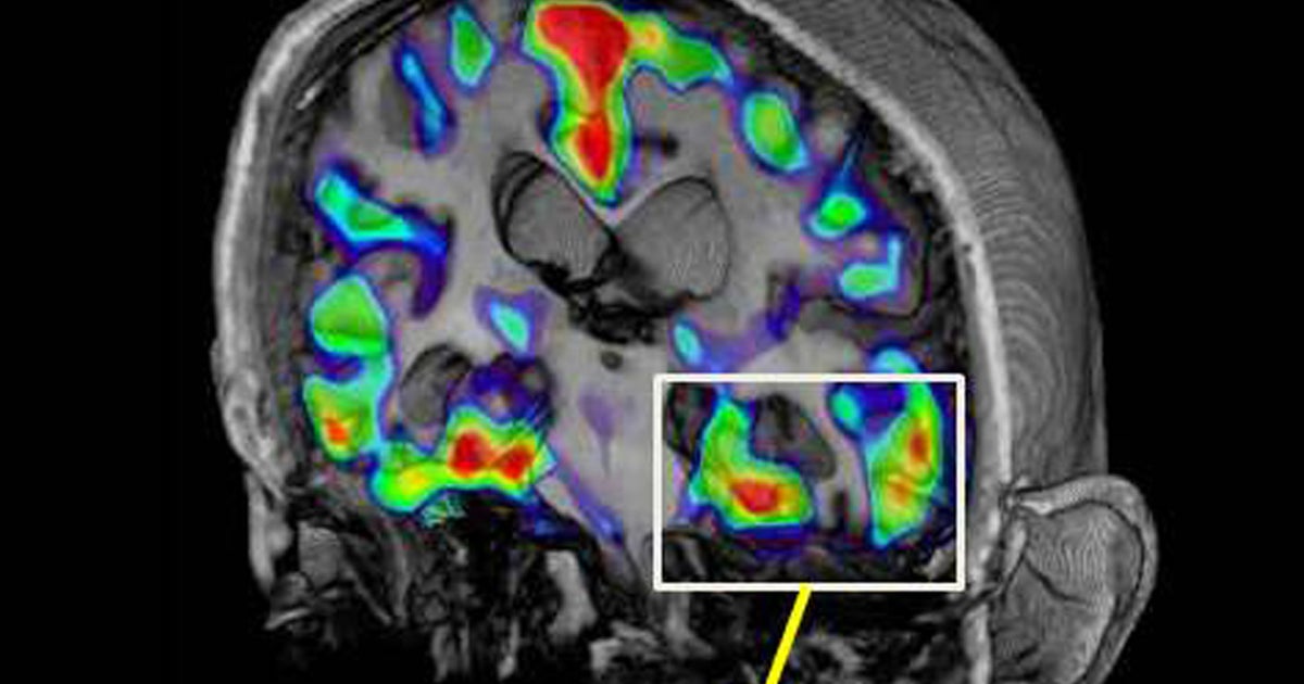New scan may diagnose Alzheimer's as brain changes occur - CBS News