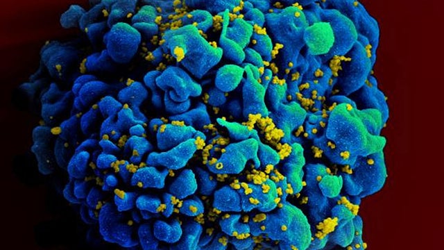 hiv virus, aids 