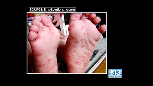 hand-foot-and-mouth-disease.jpg 
