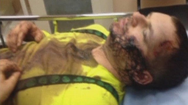 Ukrainian opposition activist Dmytro Bulatov lays on a hospital bed in Kiev after two weeks of alleged beatings and torture at the hands of unidentified kidnappers 