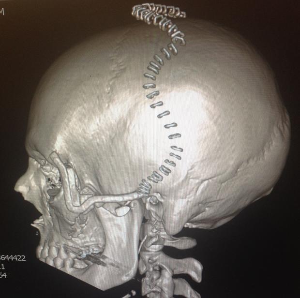 004-implants-x-ray.jpg 