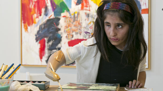 Afghan girl paints with help of prosthetic arm 