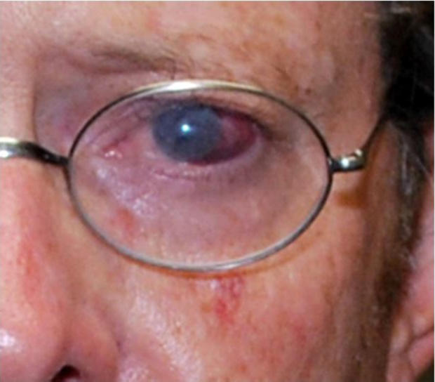 Dr. Wall's eye injury 