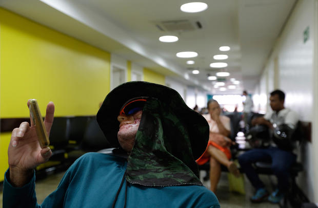Rare disease afflicts Brazilian village 