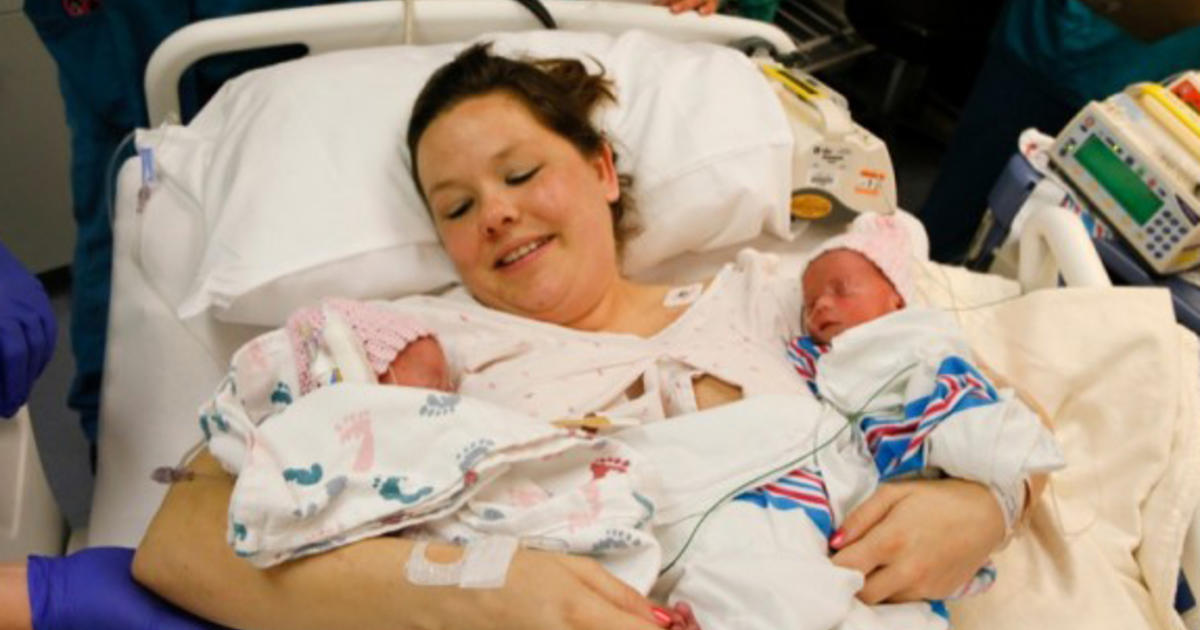 Rare Mono Mono Twins Hold Hands At Birth Cbs News