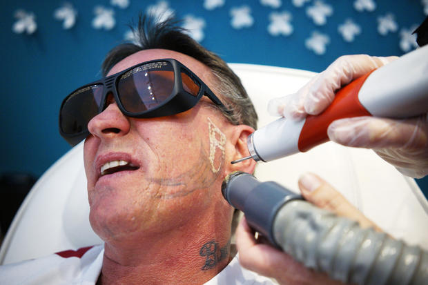 Tattoo removal for ex-convicts 