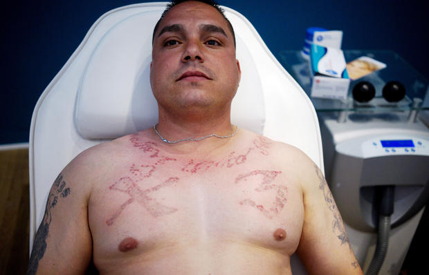 Tattoo removal for ex-convicts 