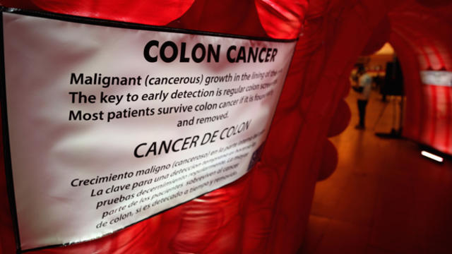 colon_cancer.jpg 