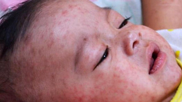 stream0113measles330982640x360.jpg