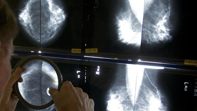 mammogram2.jpg 
