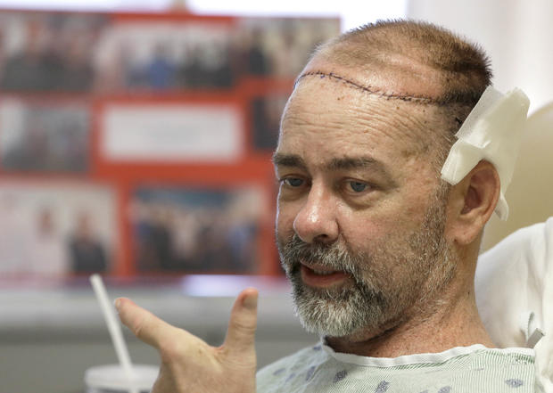 James Boysen received skull, scalp transplant 
