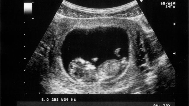 ultrasound fetus 