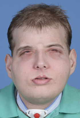 Patrick Hardison face transplant.png 