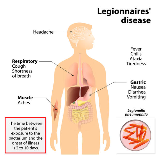 Legionnaires disease or legionellosis 