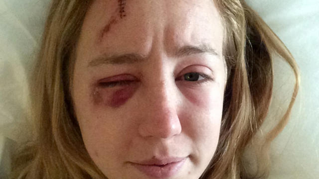 Mollyann Hart poses for a selfie showing injuries from a lightning strike while recovering at a hospital in Hagerstown, Md., in this June 19, 2015, photo provided by Hart. 