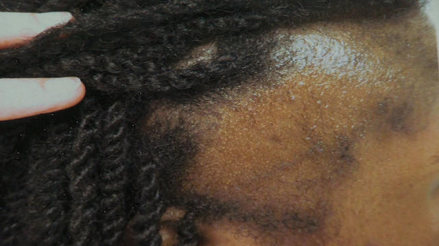 traction-alopecia.jpg 