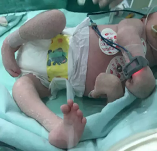 newborn-with-deformed-limbs-zika.png 