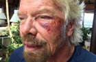 Sir Richard Branson is seen in an undated handout image issued by Virgin.com on Aug. 26, 2016, after he was involved in an accident when he crashed his bicycle on Virgin Gorda, one of the British Virgin Islands in the Caribbean. 