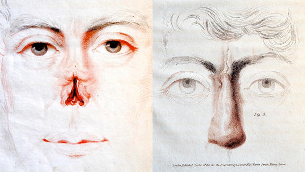 joseph-constantine-carpue-nasal-reconstruction-surgery-620.jpg 