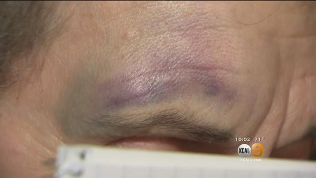 black-eye In Home Invasion Robbery 