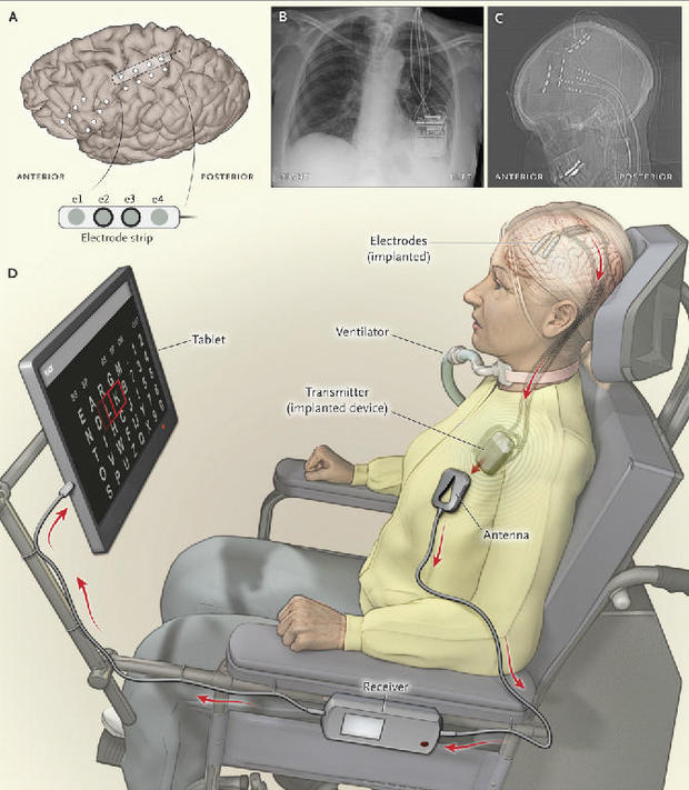 als-brain-implant-illustration.jpg 