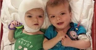 Formerly conjoined twins Jadon and Anias McDonald begin rehab CBS News