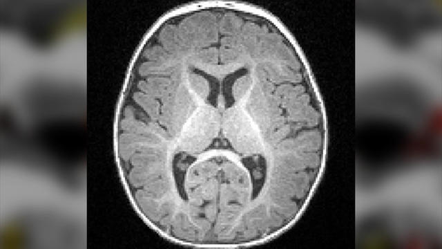 autism-brain-scan-unc-chapelhill-1252319-640x360.jpg 