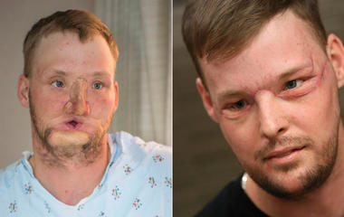 Amazing face transplants (GRAPHIC IMAGES) 