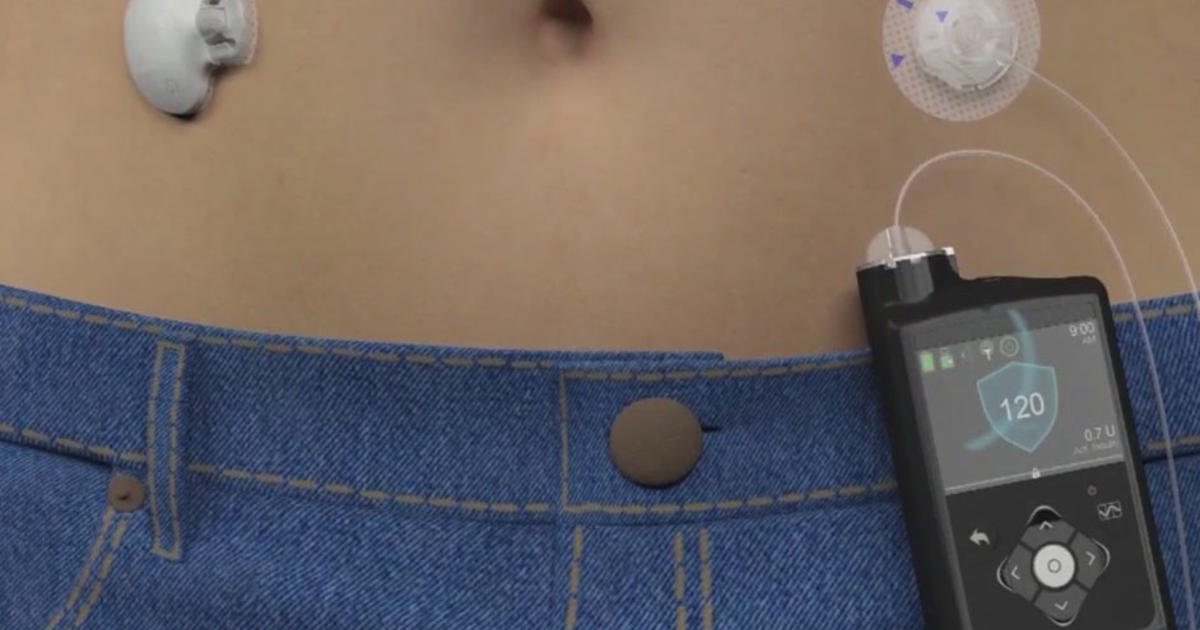 Artificial Pancreas Simplifies Life For Connecticut Teen With Type 1 ...