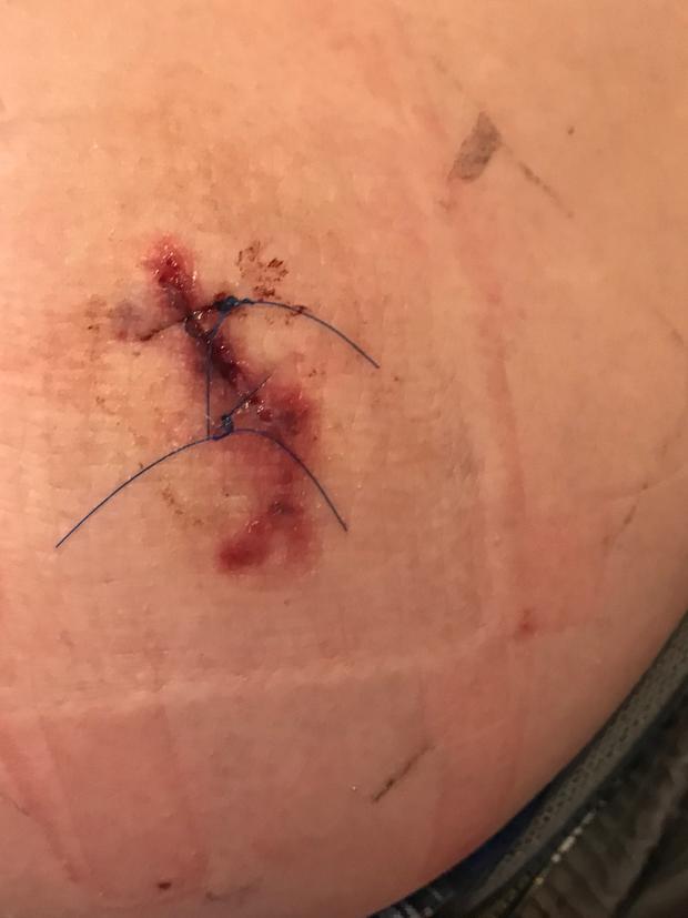 stitches 