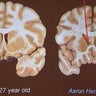 aaronhernandezbrain.jpg 