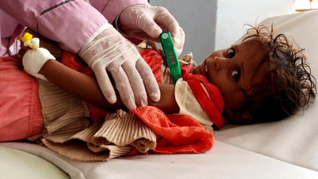 yemen-child-with-cholera.jpg 