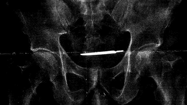 Left Behind Scalpel Lawsuit 
