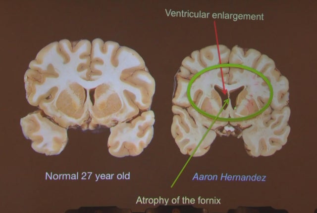 cte-hernandez-brain.jpg