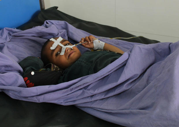 An Afghan child receives treatment at a hospital after MondayÕs airstrike in Kunduz province, Afghanistan 