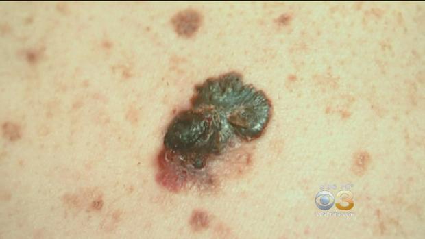 Dermatologists Bringing Attention To Skin Cancer On Melanoma Monday 