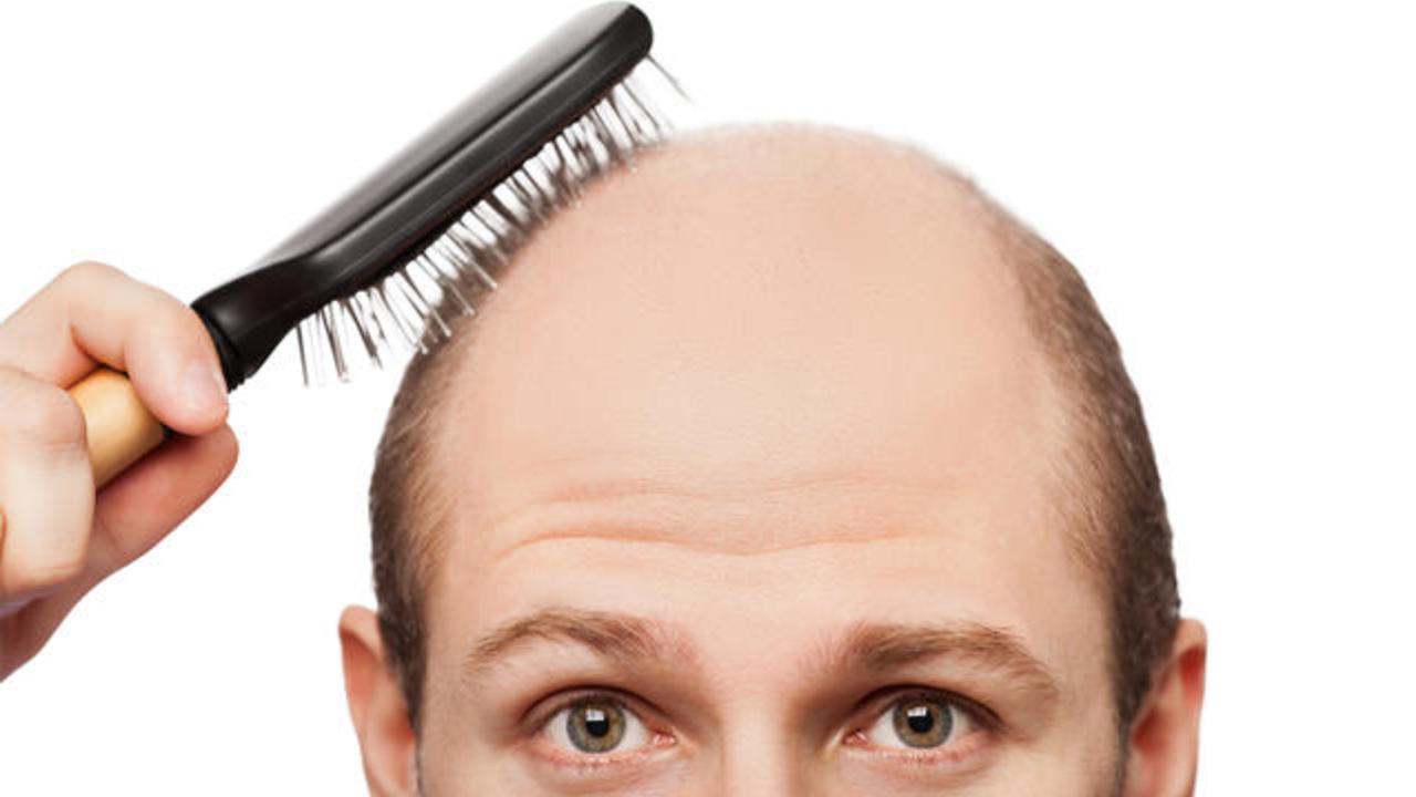 Researchers say experimental drug could lead to treatment for baldness -  CBS News