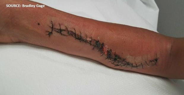 Incision on Robert Ruiz Domingues's arm (SOURCE: Bradley Gage) 