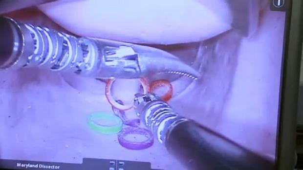 Robot Spinal Surgery 