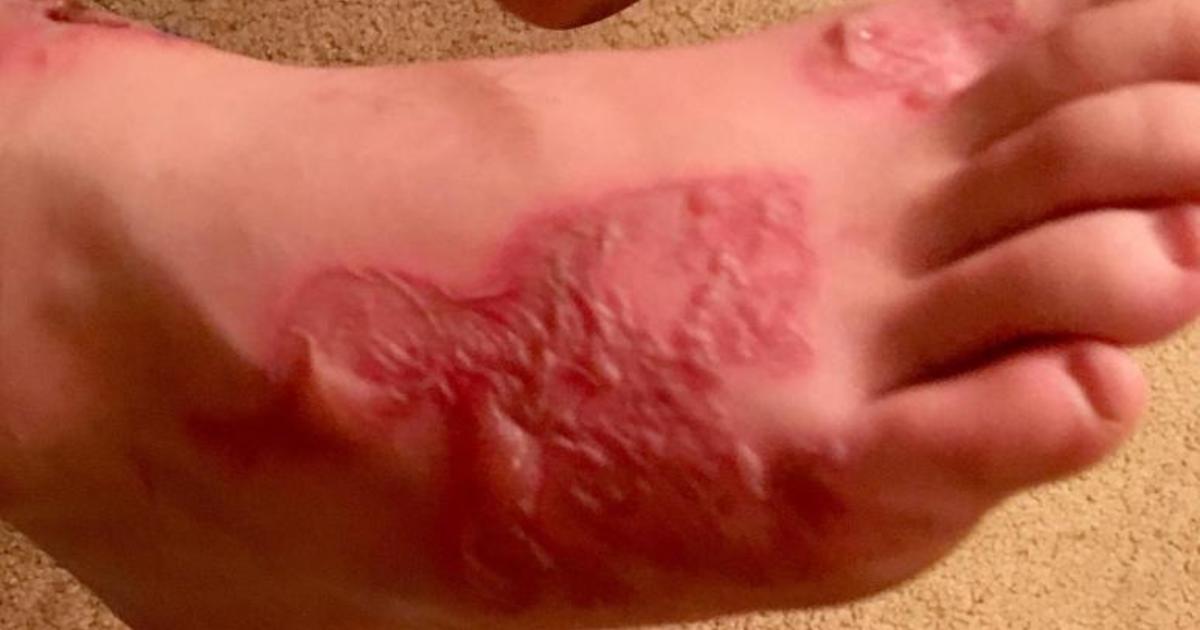How do you get hookworms? Teen's infection raises questions - CBS News